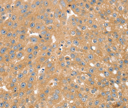 Immunohistochemistry of paraffin-embedded Human breast cancer using SNX2 Polyclonal Antibody at dilution of 1:40