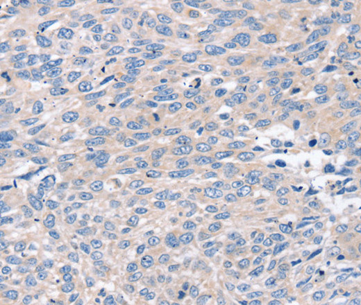 Immunohistochemistry of paraffin-embedded Human lung cancer tissue using ROR1 Polyclonal Antibody at dilution 1:35