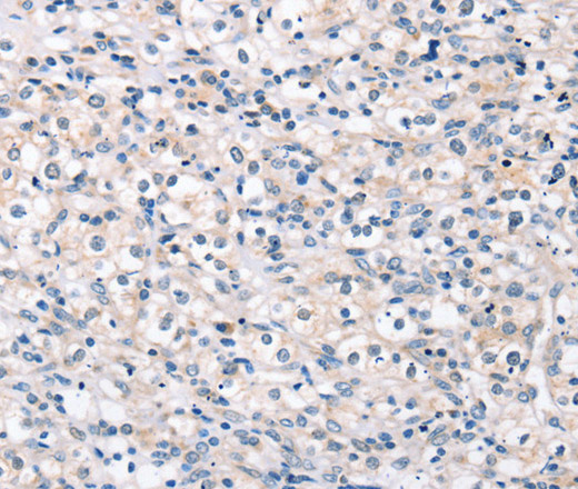 Immunohistochemistry of paraffin-embedded Human prostate cancer tissue using ROR1 Polyclonal Antibody at dilution 1:35