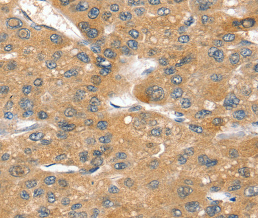 Immunohistochemistry of paraffin-embedded Human liver cancer tissue using SORT1 Polyclonal Antibody at dilution 1:40