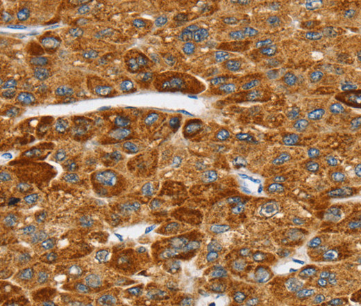 Immunohistochemistry of paraffin-embedded Human liver cancer tissue using SPARCL1 Polyclonal Antibody at dilution 1:30