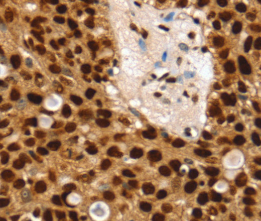 Immunohistochemistry of paraffin-embedded Human breast cancer using SSB Polyclonal Antibody at dilution of 1:30