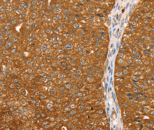 Immunohistochemistry of paraffin-embedded Human breast cancer tissue using ABCC8 Polyclonal Antibody at dilution 1:40