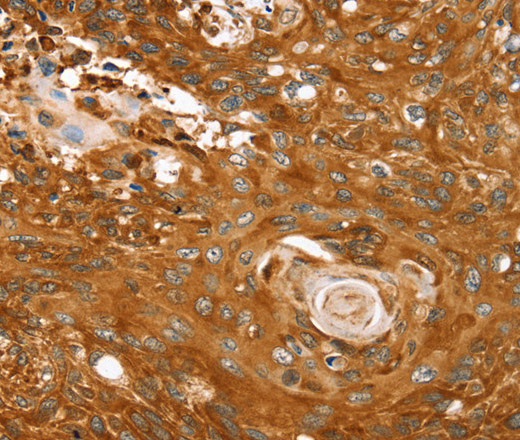 Immunohistochemistry of paraffin-embedded Human esophagus cancer tissue using ABCC8 Polyclonal Antibody at dilution 1:40