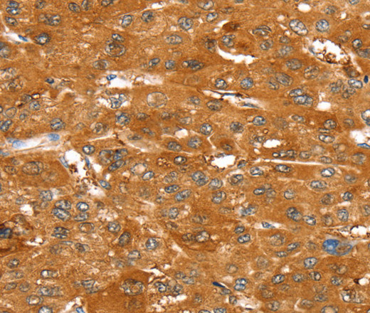 Immunohistochemistry of paraffin-embedded Human liver cancer tissue using ABCC9 Polyclonal Antibody at dilution 1:50