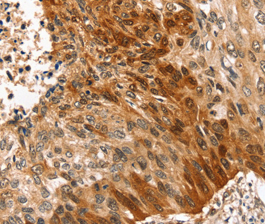 Immunohistochemistry of paraffin-embedded Human esophagus cancer tissue using SYNPO2 Polyclonal Antibody at dilution 1:50