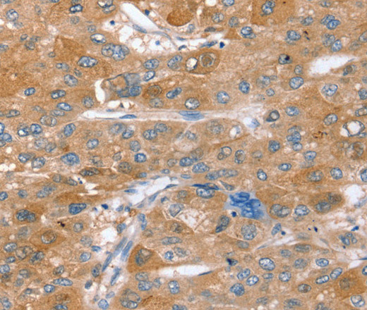 Immunohistochemistry of paraffin-embedded Human liver cancer using STX2 Polyclonal Antibody at dilution of 1:40