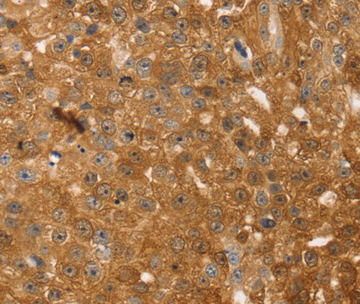 Immunohistochemistry of paraffin-embedded Human breast cancer tissue using TMSB10 Polyclonal Antibody at dilution 1:35