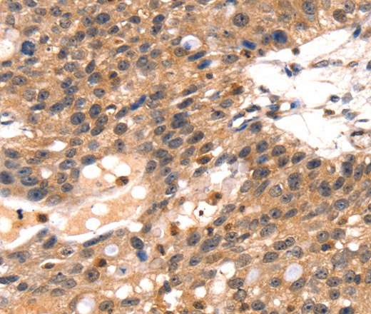 Immunohistochemistry of paraffin-embedded Human breast cancer using TLN1 Polyclonal Antibody at dilution of 1:35