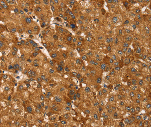 Immunohistochemistry of paraffin-embedded Human liver cancer tissue using TBC1D1 Polyclonal Antibody at dilution 1:45