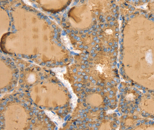 Immunohistochemistry of paraffin-embedded Human thyroid cancer tissue using TG Polyclonal Antibody at dilution 1:40