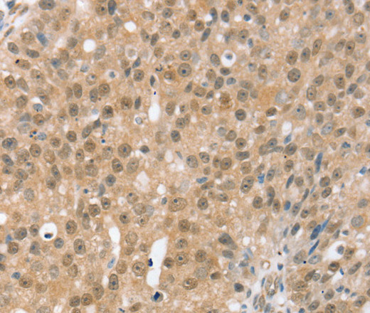 Immunohistochemistry of paraffin-embedded Human breast cancer using TRIM35 Polyclonal Antibody at dilution of 1:35