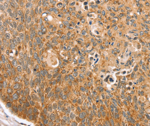 Immunohistochemistry of paraffin-embedded Human esophagus cancer using TRIM62 Polyclonal Antibody at dilution of 1:30