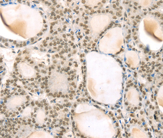 Immunohistochemistry of paraffin-embedded Human thyroid cancer using TSPAN13 Polyclonal Antibody at dilution of 1:35