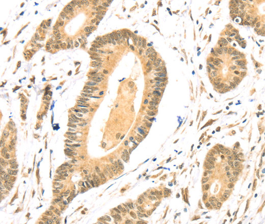 Immunohistochemistry of paraffin-embedded Human colon cancer using TSPAN13 Polyclonal Antibody at dilution of 1:35