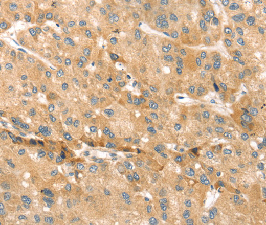 Immunohistochemistry of paraffin-embedded Human liver cancer using EVA1A Polyclonal Antibody at dilution of 1:30