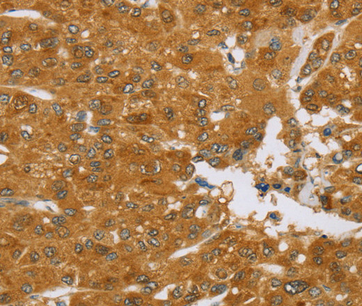 Immunohistochemistry of paraffin-embedded Human liver cancer tissue using TNFSF13 Polyclonal Antibody at dilution 1:40