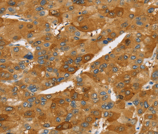 Immunohistochemistry of paraffin-embedded Human liver cancer using TNFSF15 Polyclonal Antibody at dilution of 1:40