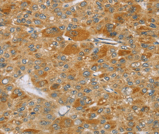 Immunohistochemistry of paraffin-embedded Human liver cancer using TP53I11 Polyclonal Antibody at dilution of 1:40