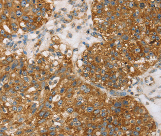 Immunohistochemistry of paraffin-embedded Human breast cancer using TPD54 Polyclonal Antibody at dilution of 1:35