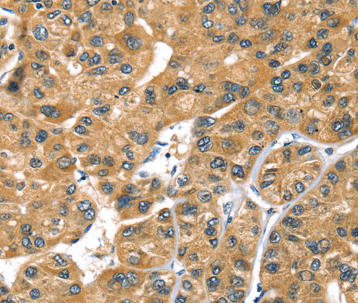 Immunohistochemistry of paraffin-embedded Human liver cancer using PRSS50 Polyclonal Antibody at dilution of 1:30