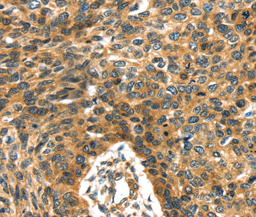 Immunohistochemistry of paraffin-embedded Human esophagus cancer using PRSS50 Polyclonal Antibody at dilution of 1:30