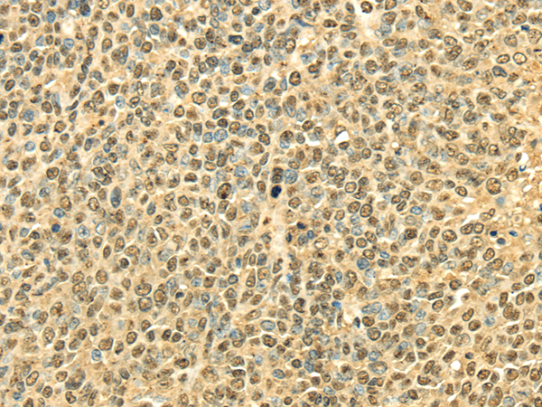 Immunohistochemistry of paraffin-embedded Human ovarian cancer using RPA2 Polyclonal Antibody at dilution of  1/40