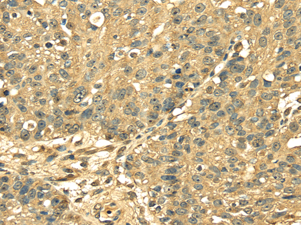 Immunohistochemistry of paraffin-embedded Human breast cancer using RPS3 Polyclonal Antibody at dilution of  1/25