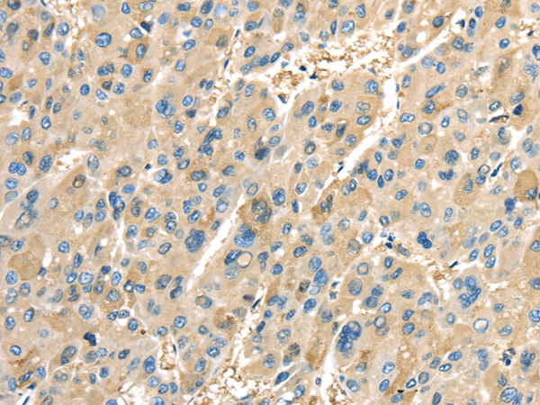 Immunohistochemistry of paraffin-embedded Human liver cancer tissue using COX2 Polyclonal Antibody at dilution 1:40