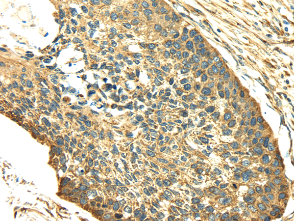 Immunohistochemistry of paraffin-embedded Human esophagus cancer tissue using SDF4 Polyclonal Antibody at dilution 1:40