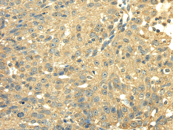Immunohistochemistry of paraffin-embedded Human breast cancer using SDHA Polyclonal Antibody at dilution of  1/40