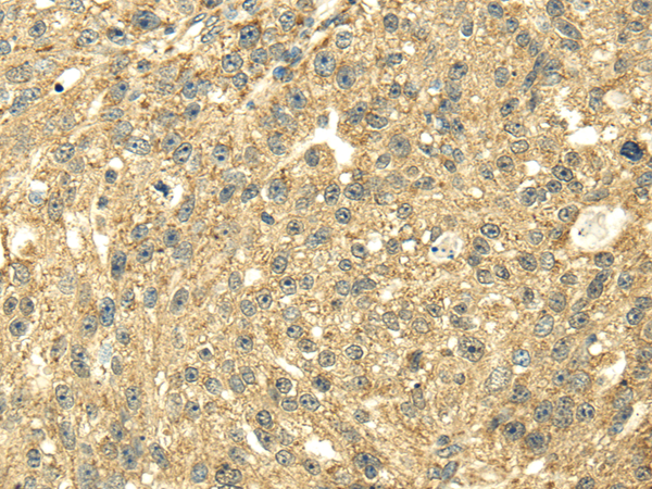 Immunohistochemistry of paraffin-embedded Human breast cancer using SDHA Polyclonal Antibody at dilution of  1/40