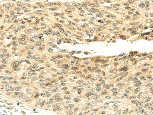 Immunohistochemistry of paraffin-embedded Human lung cancer tissue using SHPRH Polyclonal Antibody at dilution 1:45