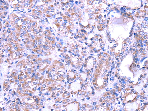 Immunohistochemistry of paraffin-embedded Human thyroid cancer tissue using SRPK1 Polyclonal Antibody at dilution 1:35