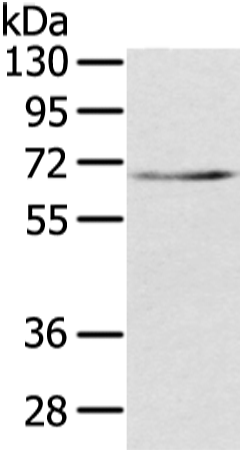 Western Blot analysis of Human lung cancer tissue using TBL1X Polyclonal Antibody at dilution of 1/500