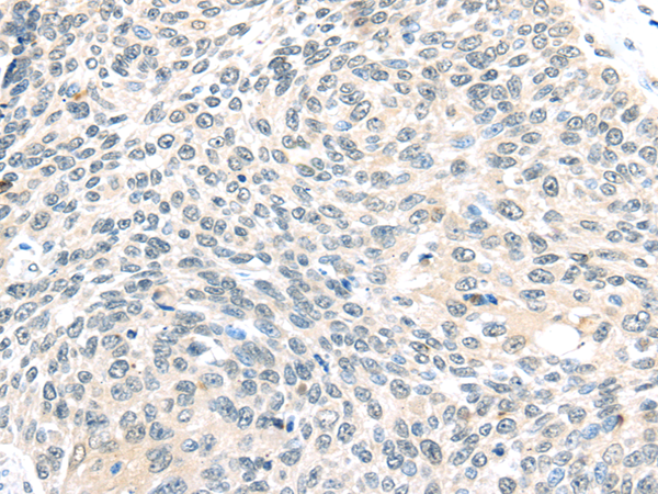 Immunohistochemistry of paraffin-embedded Human lung cancer tissue using ELOC Polyclonal Antibody at dilution 1:40