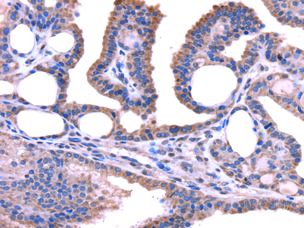 Immunohistochemistry of paraffin-embedded Human thyroid cancer tissue using TRIM49 Polyclonal Antibody at dilution 1:40
