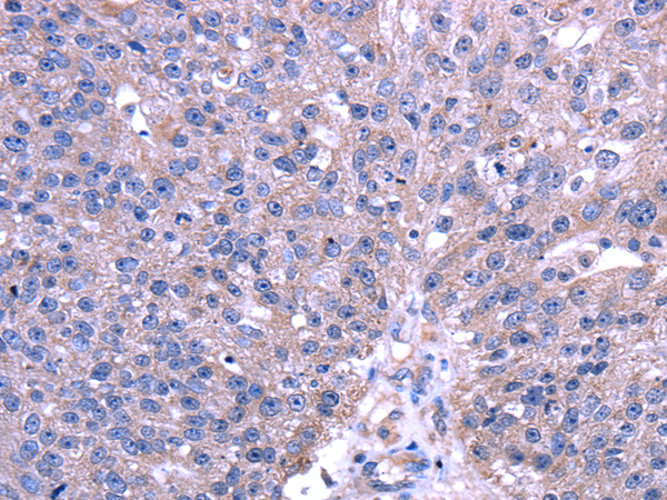 Immunohistochemistry of paraffin-embedded Human breast cancer using TRIM49 Polyclonal Antibody at dilution of  1/40