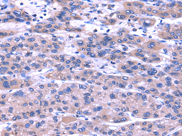 Immunohistochemistry of paraffin-embedded Human liver cancer using TRIM49 Polyclonal Antibody at dilution of  1/40