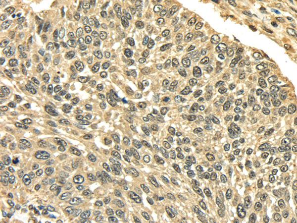 Immunohistochemistry of paraffin-embedded Human lung cancer using PLIN3 Polyclonal Antibody at dilution of  1/35