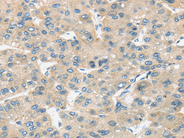 Immunohistochemistry of paraffin-embedded Human liver cancer tissue using TIRAP Polyclonal Antibody at dilution 1:30