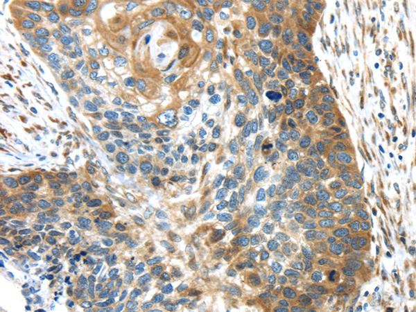 Immunohistochemistry of paraffin-embedded Human esophagus cancer using TMED4 Polyclonal Antibody at dilution of  1/45