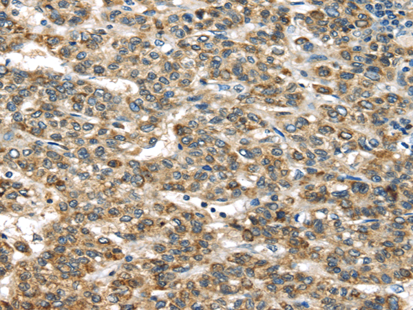 Immunohistochemistry of paraffin-embedded Human liver cancer tissue using TNFAIP2 Polyclonal Antibody at dilution 1:40