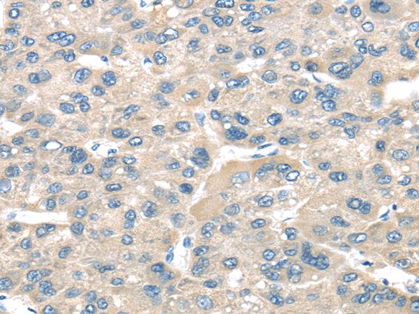 Immunohistochemistry of paraffin-embedded Human liver cancer tissue using TNFAIP8 Polyclonal Antibody at dilution 1:35