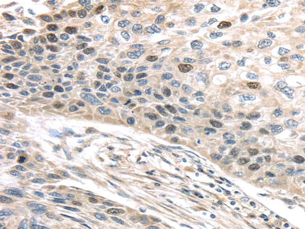 Immunohistochemistry of paraffin-embedded Human esophagus cancer using TPX2 Polyclonal Antibody at dilution of  1/40