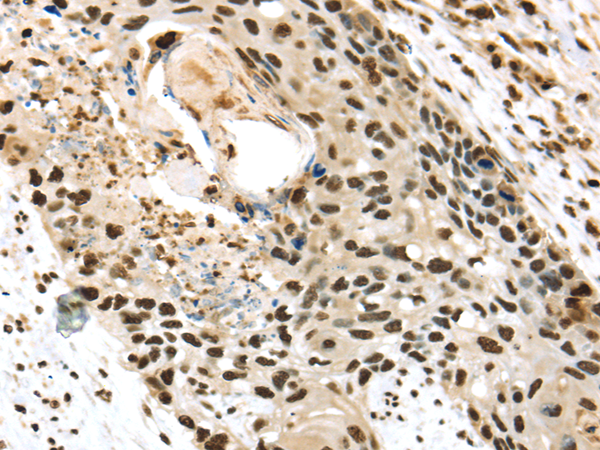 Immunohistochemistry of paraffin-embedded Human esophagus cancer using TALDO1 Polyclonal Antibody at dilution of  1/30