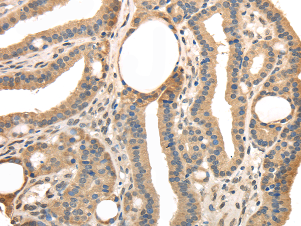 Immunohistochemistry of paraffin-embedded Human thyroid cancer tissue using TRIB3 Polyclonal Antibody at dilution 1:40