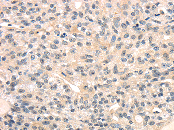 Immunohistochemistry of paraffin-embedded Human breast cancer tissue using TRIB3 Polyclonal Antibody at dilution 1:40