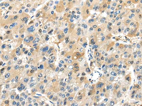 Immunohistochemistry of paraffin-embedded Human liver cancer tissue using TRAIP Polyclonal Antibody at dilution 1:40