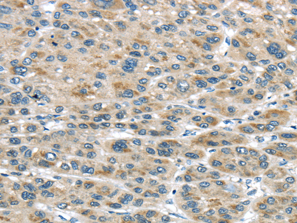 Immunohistochemistry of paraffin-embedded Human liver cancer tissue using TRAIP Polyclonal Antibody at dilution 1:40